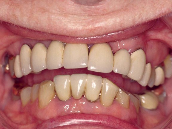 Cost Of Dentures Centrahoma OK 74534